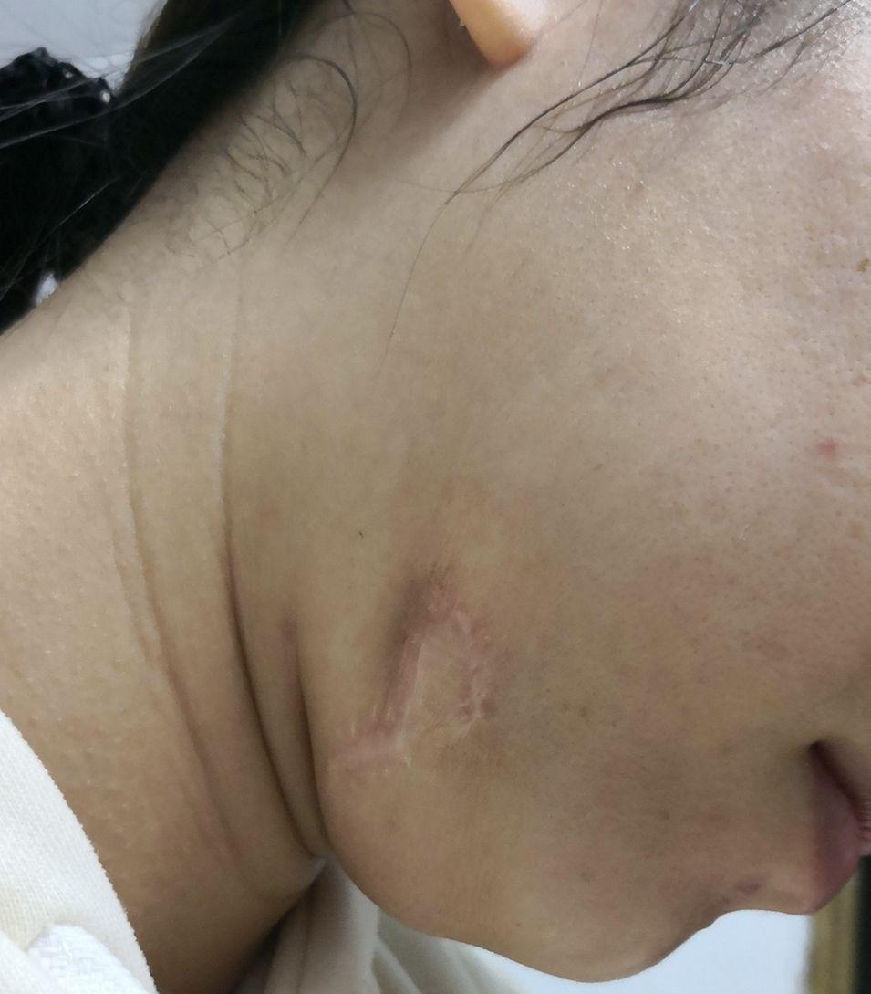 小学时牙痛引起的肿瘤后来经过一两年时间治好后留下了明显的凹凸疤痕