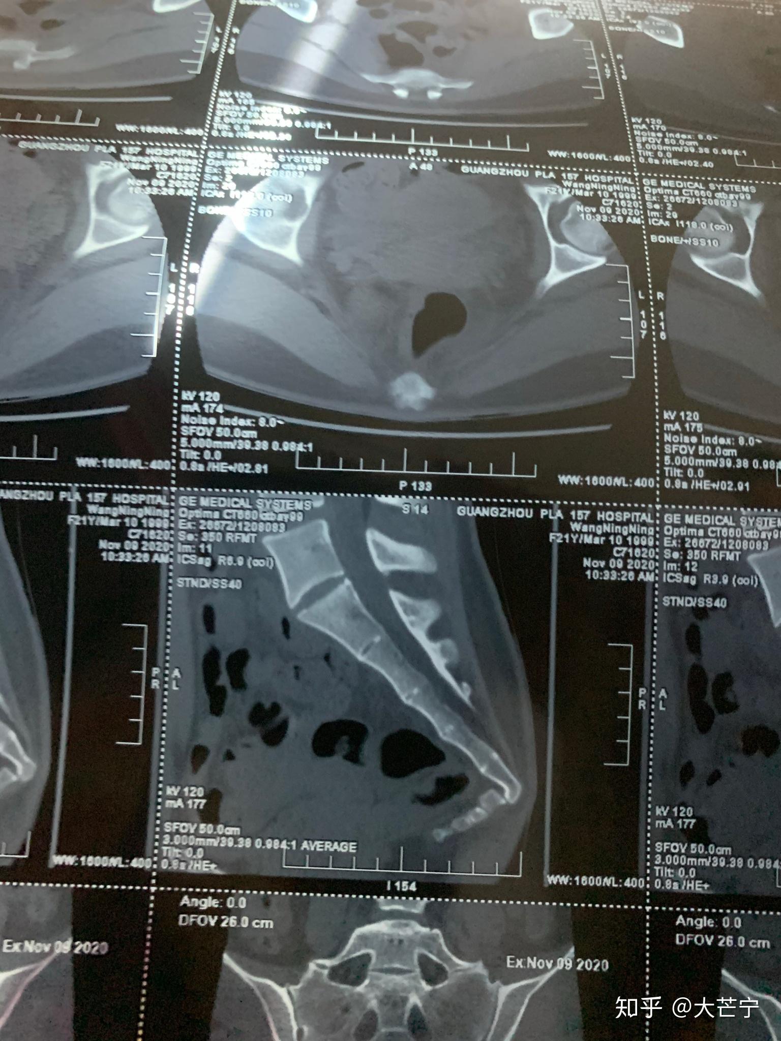 拍三维图的时候,几个医生围着我的片子 很好奇我是怎么摔的尾骨骨折