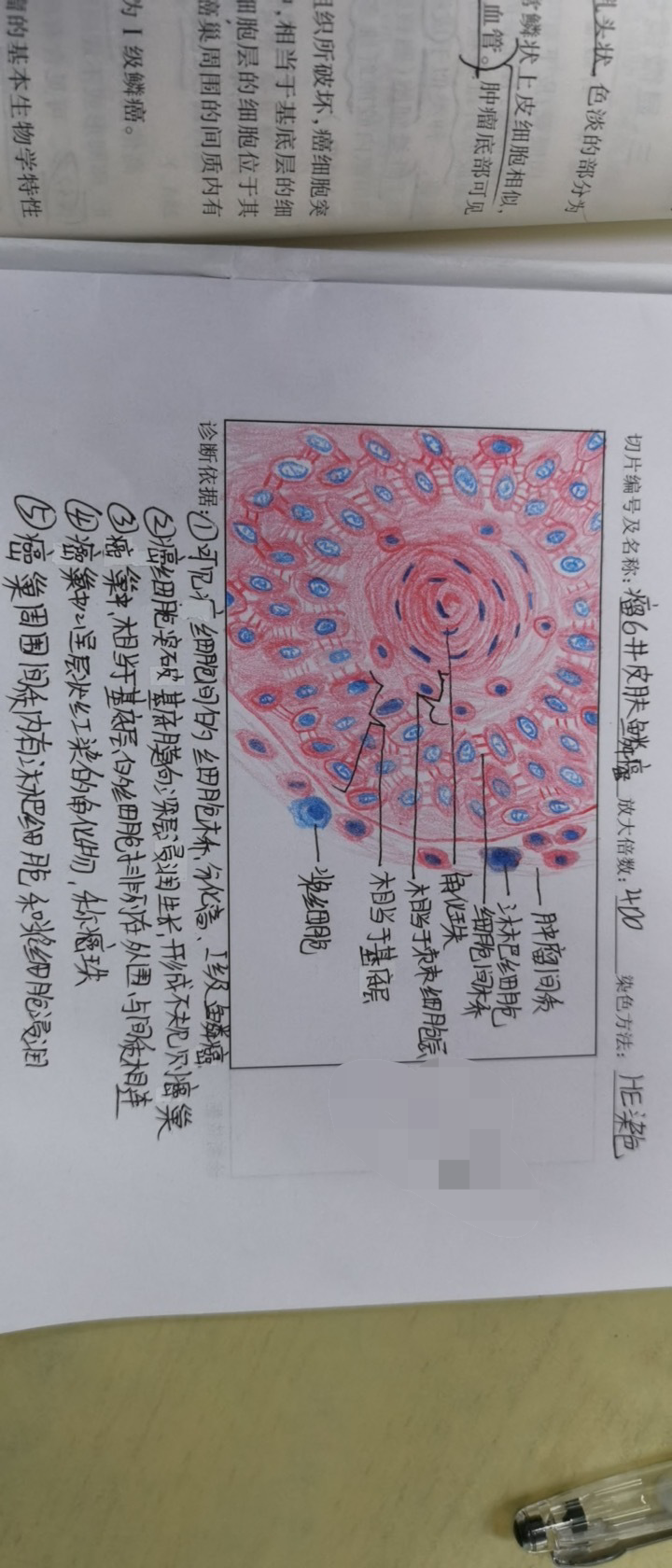 纤维肉瘤的红蓝铅笔图图片