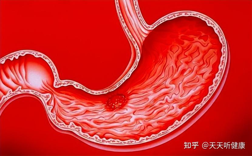胃粘膜受损逐渐加重,可能累积下面的细小血管而引发破裂出血