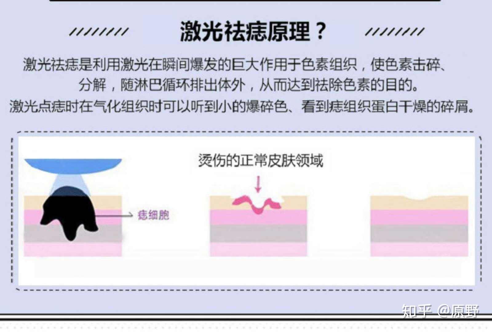 黑痣的形成原因图片