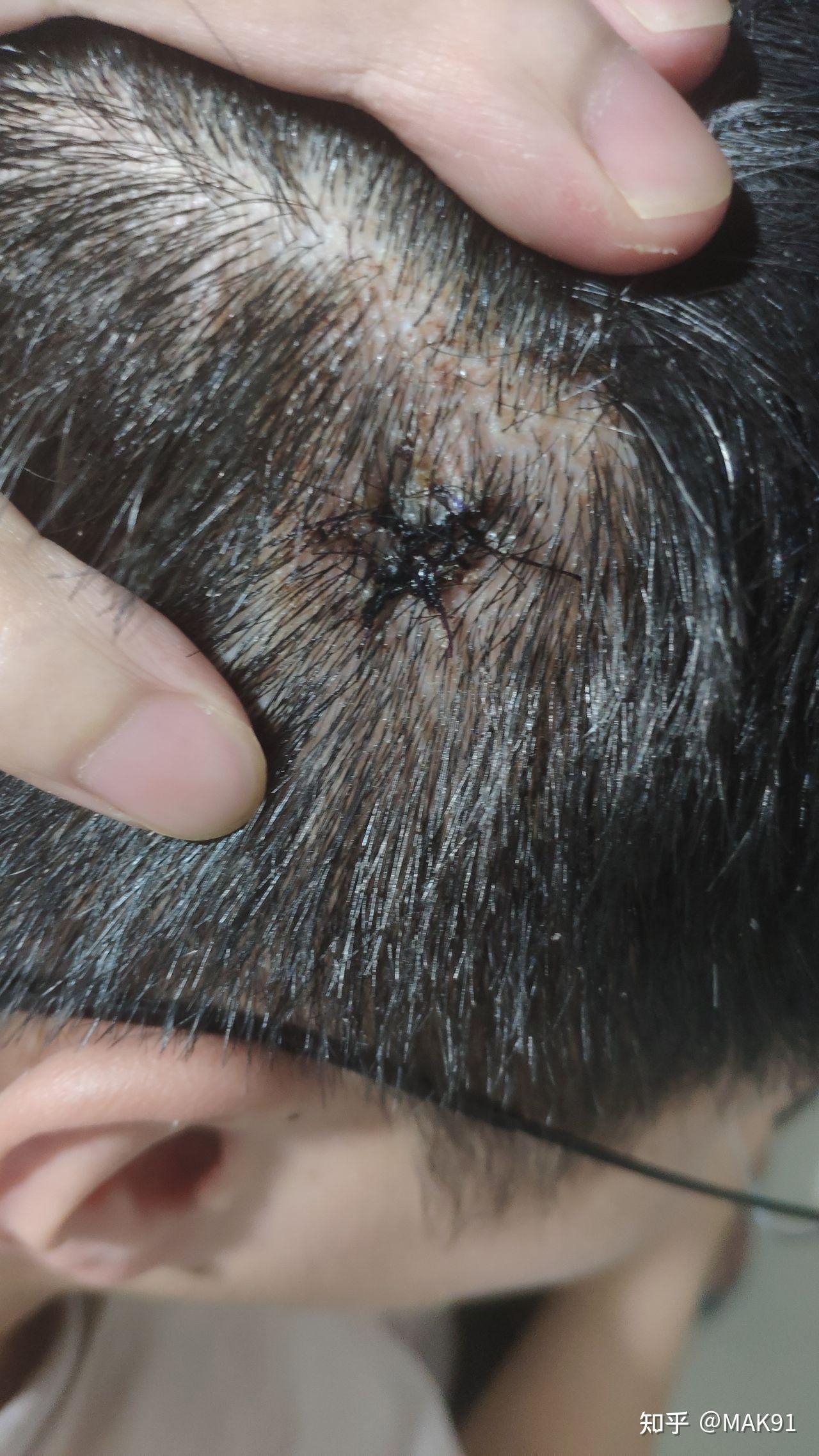 头皮上长了一个红色的小肉球不疼不痒的问一下是啥