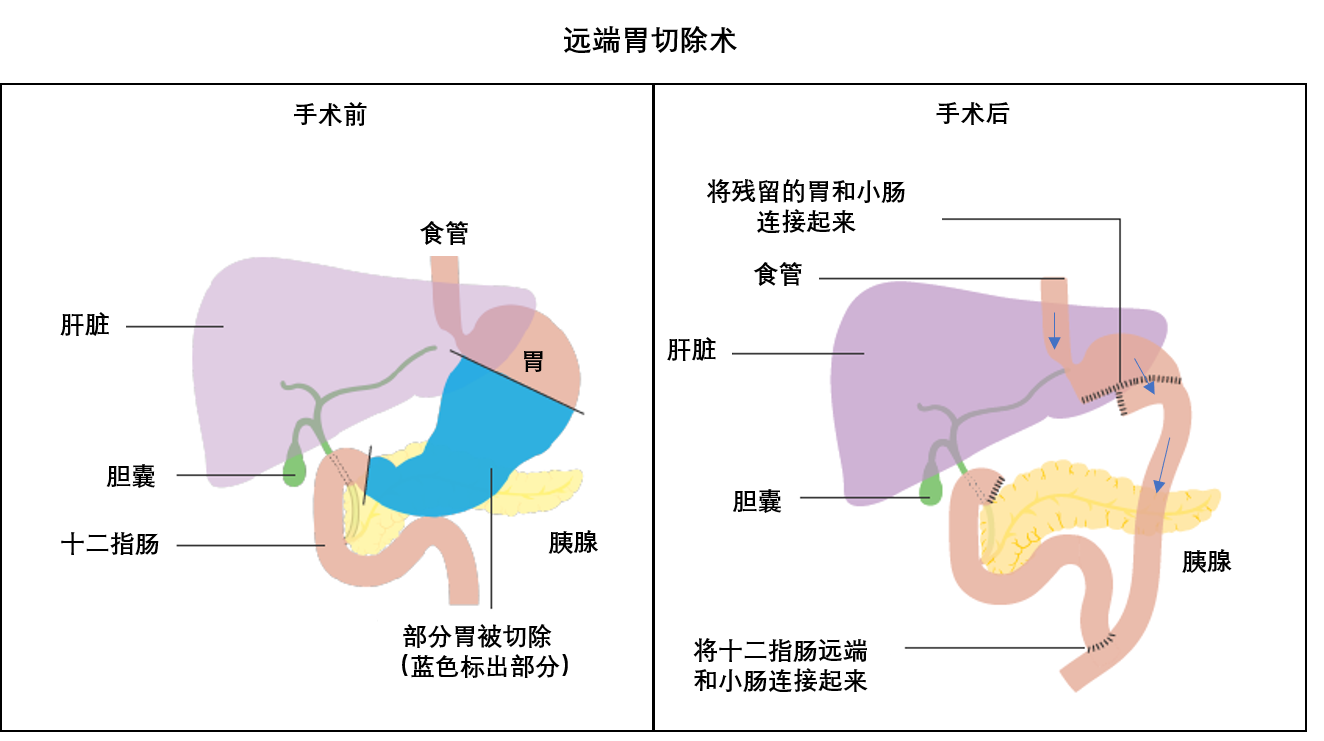 胃全切空肠代胃术图解图片