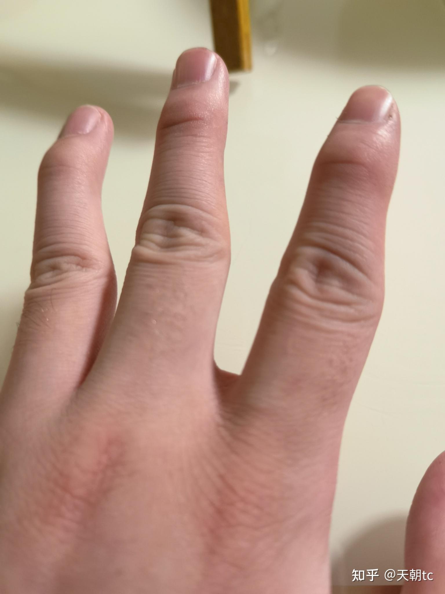 重庆14 岁学生长期喝奶茶吃垃圾食品,导致手指严重变形,垃圾食品对