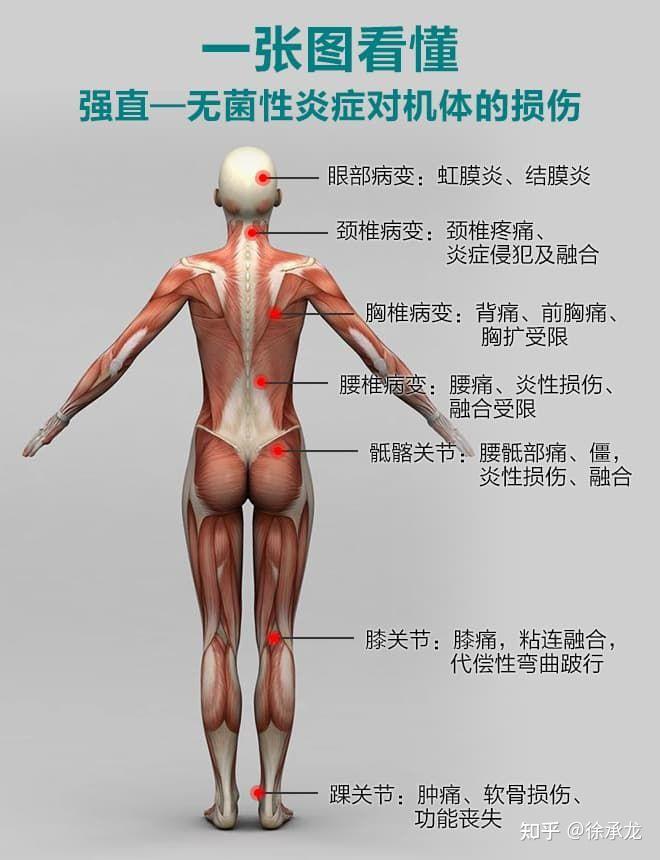 强直性脊柱炎有哪些并发症