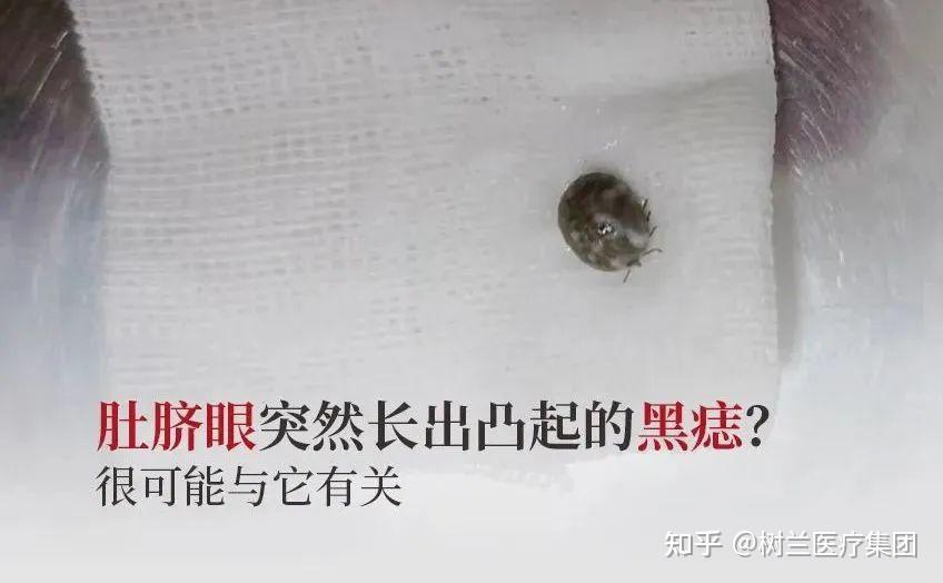 树兰(杭州)医院假期外出要当心,这种虫子悄悄叮上肚脐眼