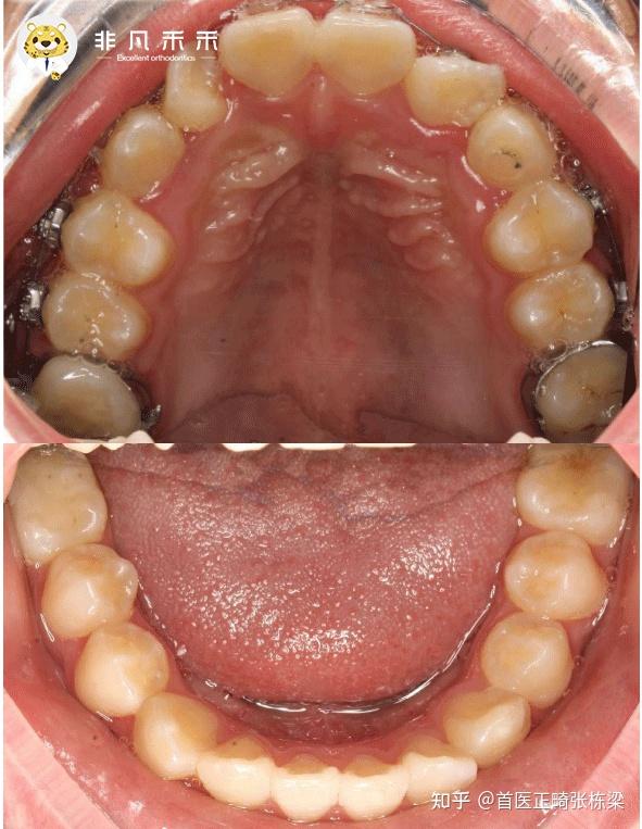 不拔牙矫正排齐严重牙齿拥挤一例
