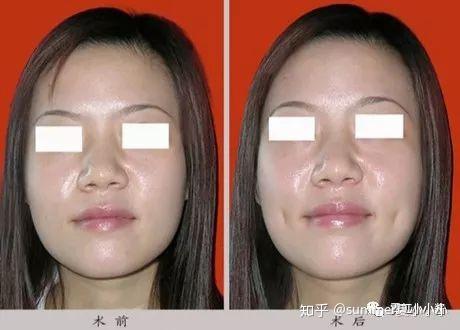 酒窝可以后天形成吗? - 知乎