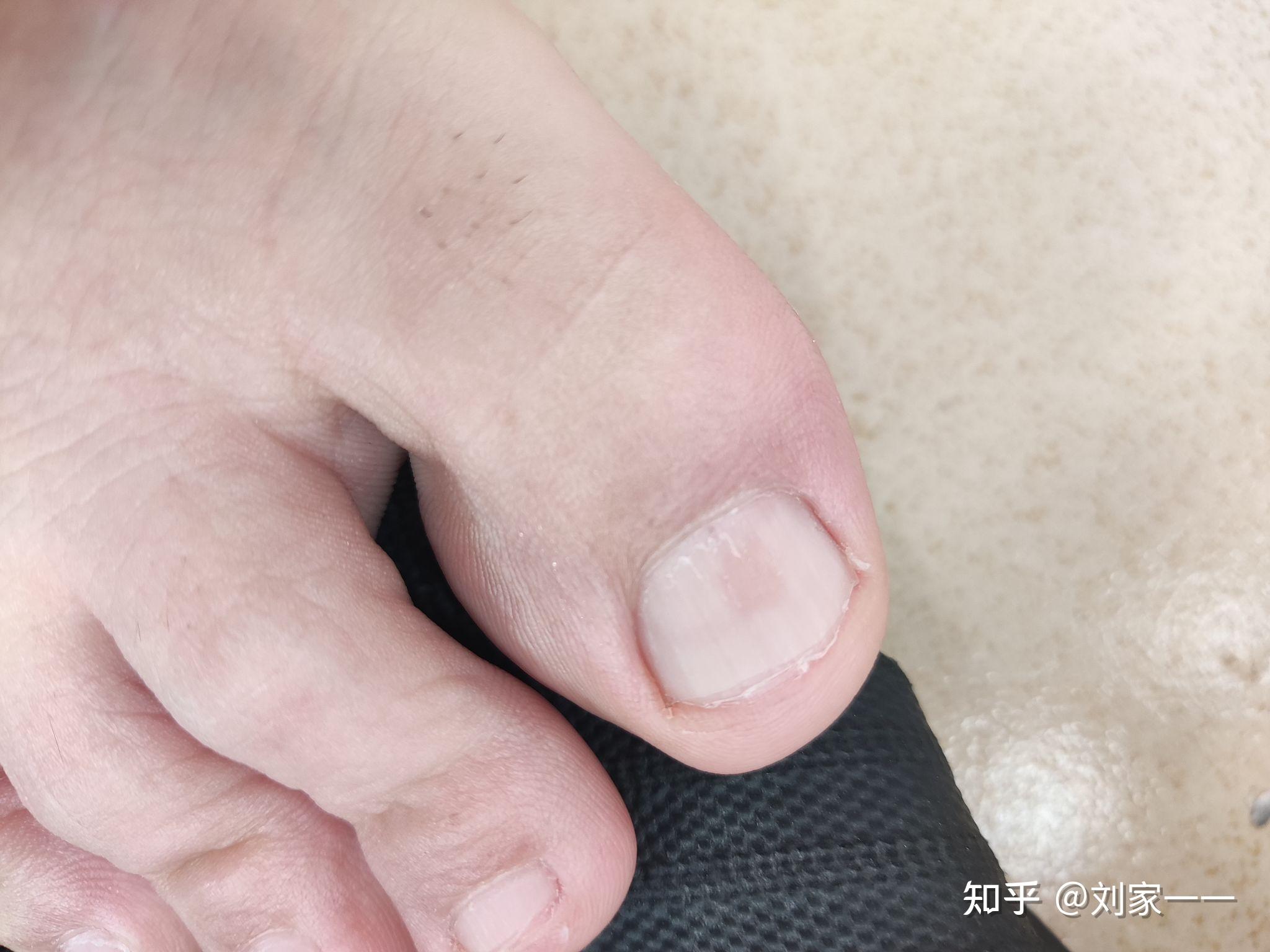 五个灰指甲治疗 - 知乎