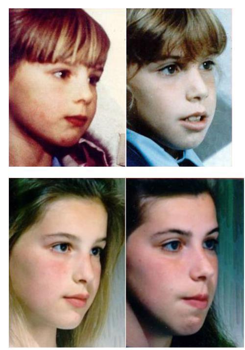 张嘴呼吸面容变丑能恢复吗? - 知乎