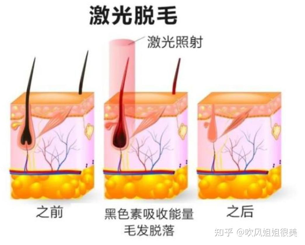 家用脱毛仪有光子也有激光，该如何选择？