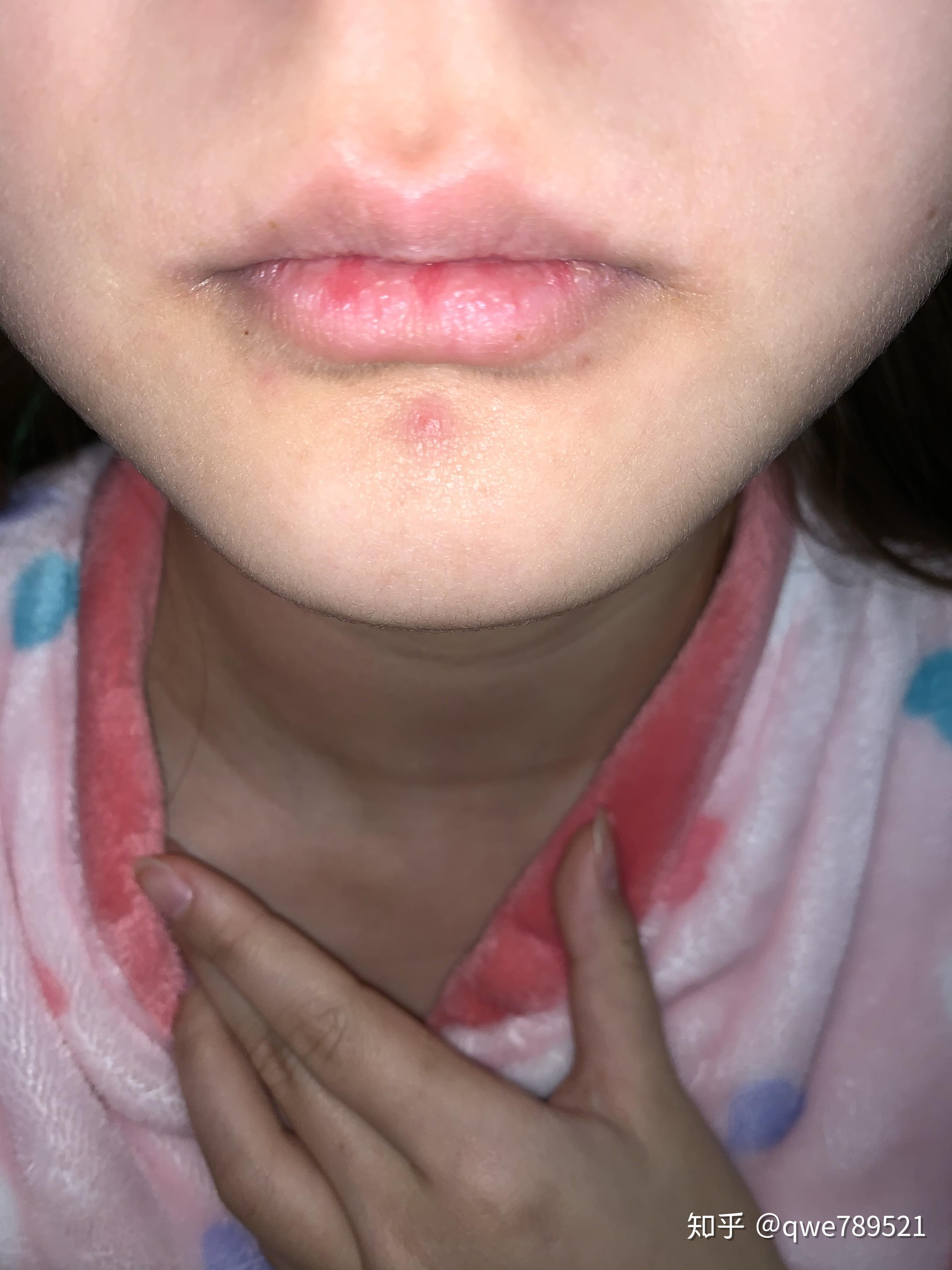 女生下巴长胡子怎么办