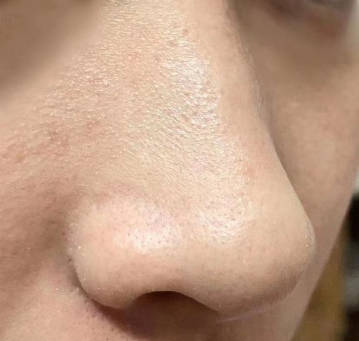 毛孔粗大满脸痘痘黑头又不会护肤护肤小白看过来超级简单的男士护肤