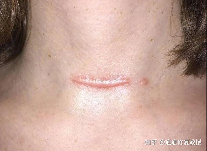 陈旧伤疤该用什么方法清除? - 知乎