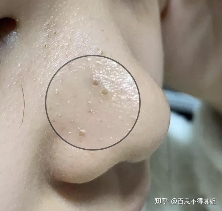 女生鼻子毛孔粗大有很多里面白色脂肪粒怎么办不好随便挤出来会有洞