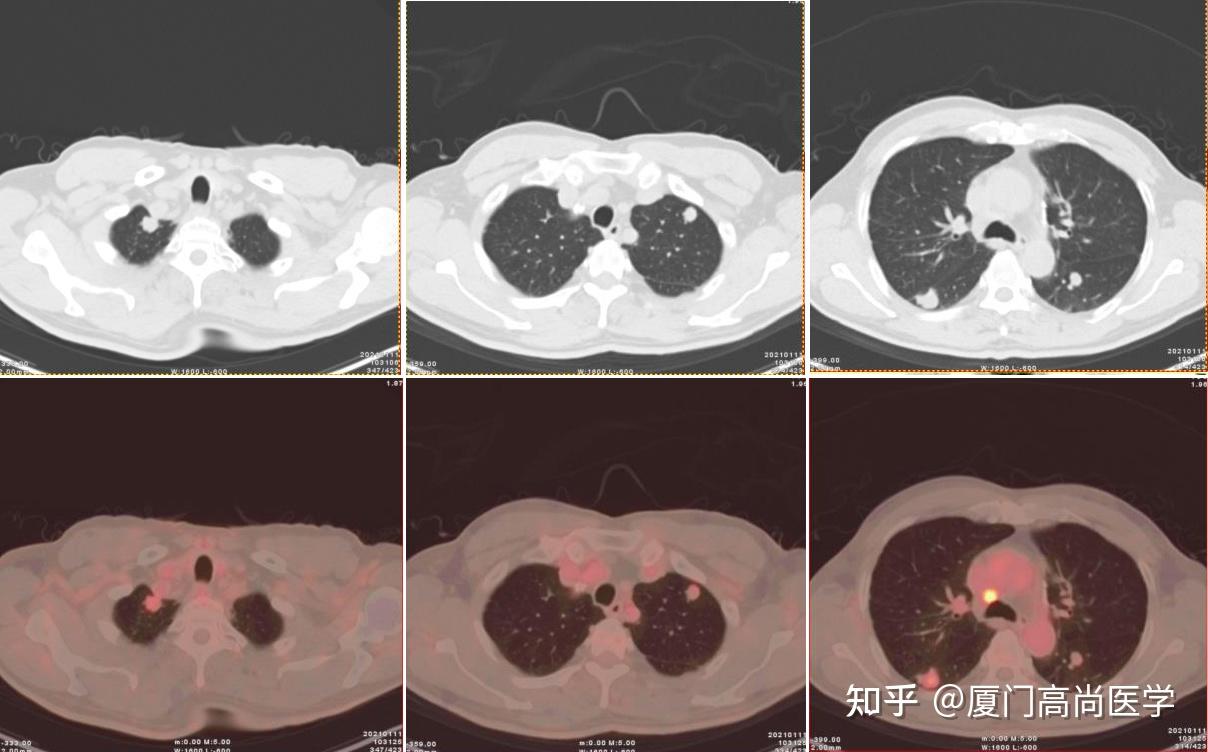 [厦门高尚医学影像]罕见病例:双肺多发腺样囊性癌1例 知乎