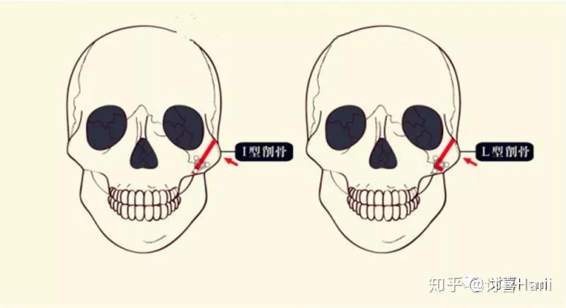 怎样判断自己颧骨高图片