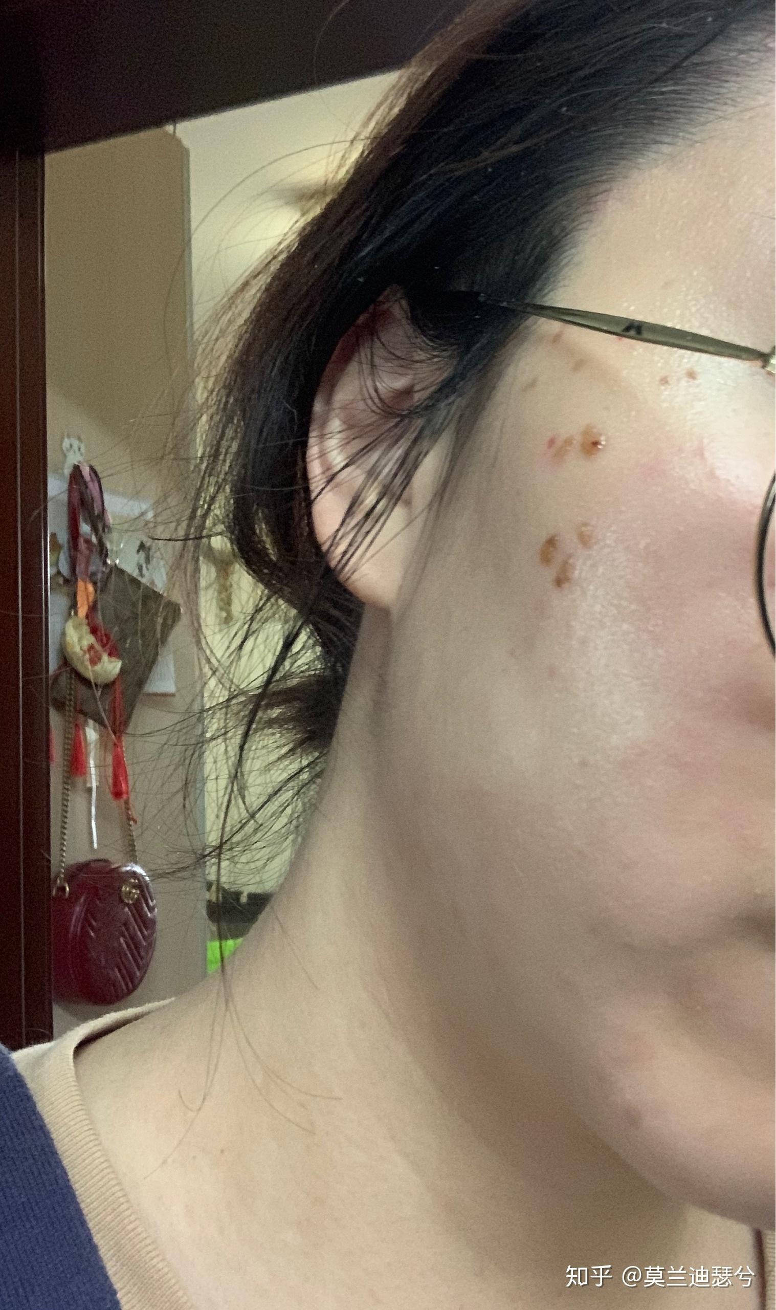 面部扁平疣脉冲激光治疗记录