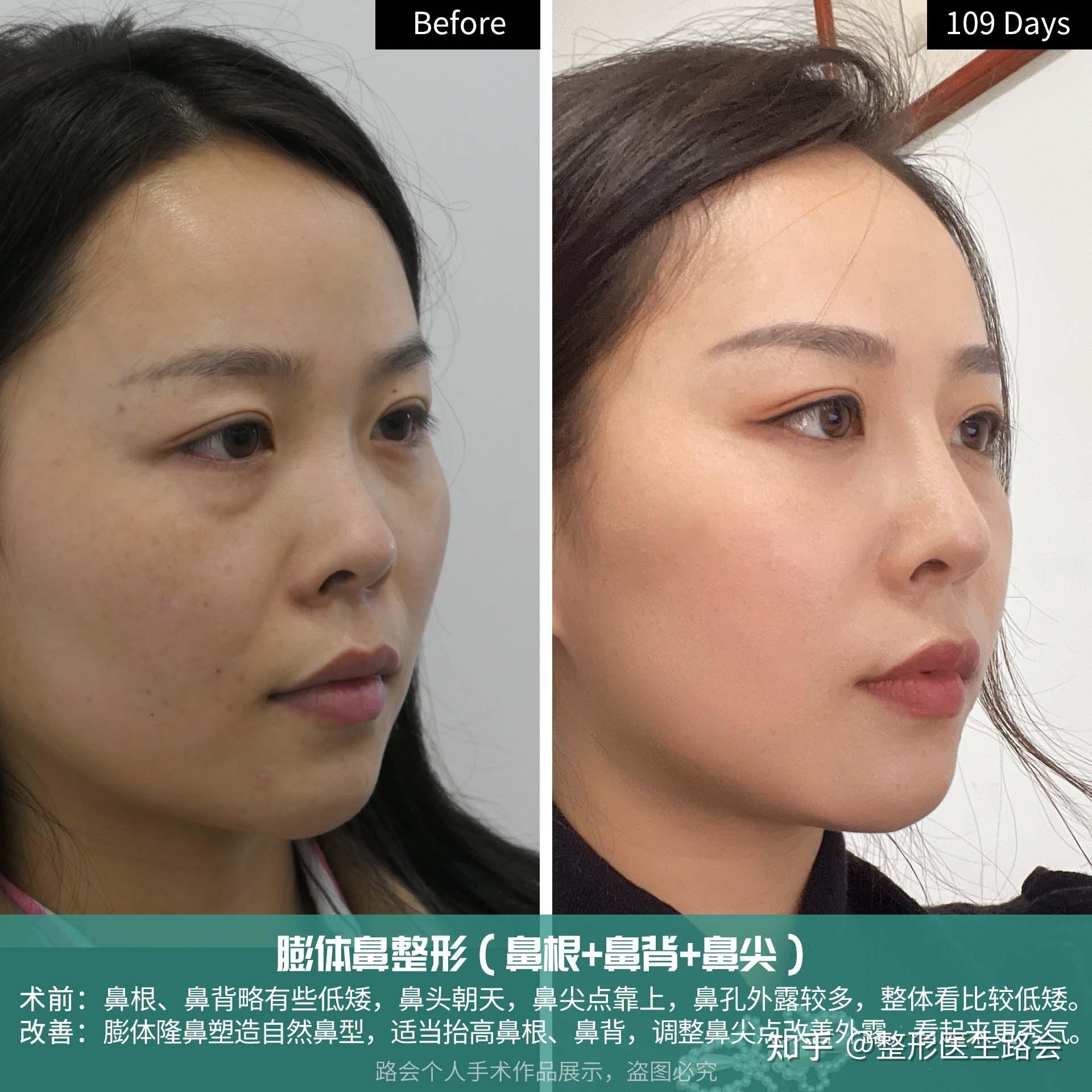 什么是朝天鼻?可纠正吗? - 知乎