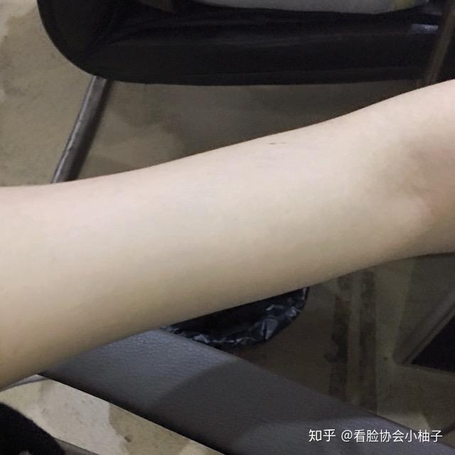 手臂吸脂术后我一个瘦子居然做了吸脂来给大家扫雷啦价格12000