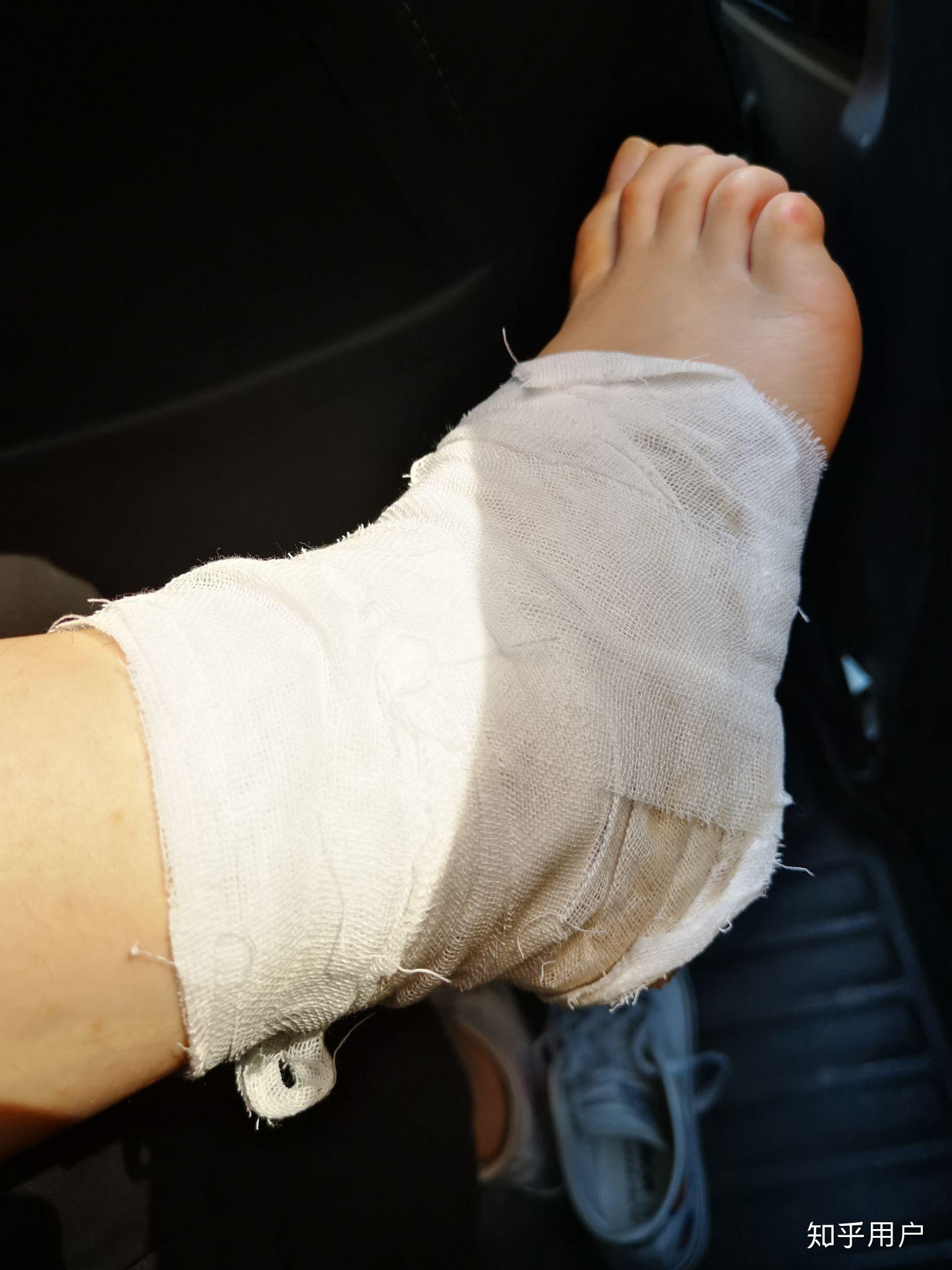 打球崴脚后最好的恢复方法是卧床吗