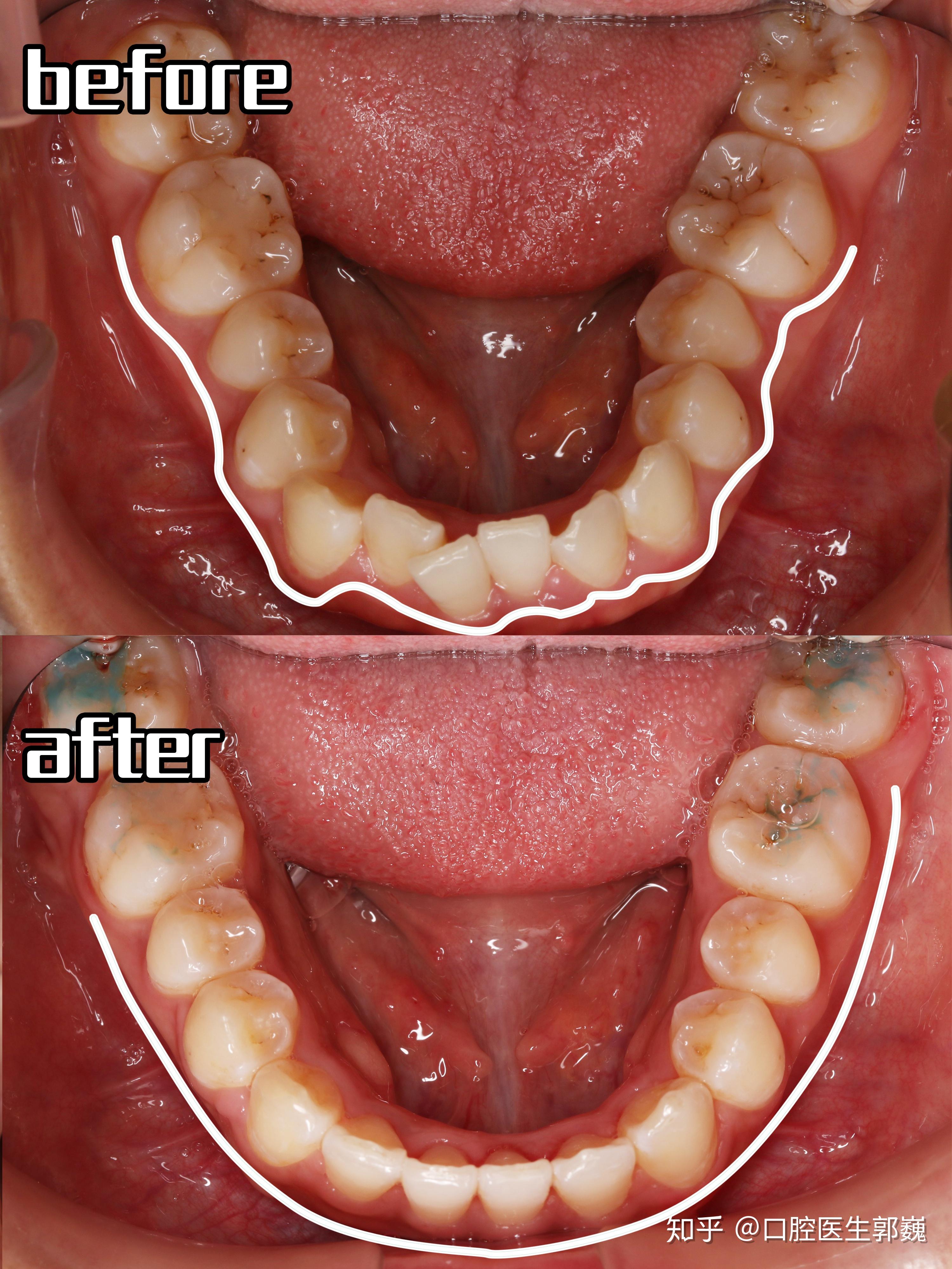牙套日记丨深覆合牙列拥挤中线不齐
