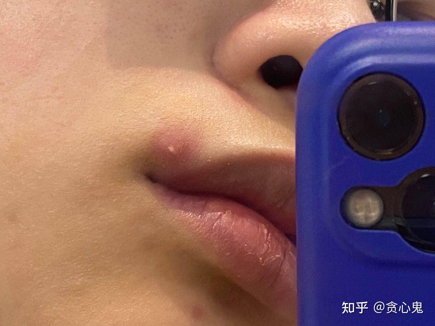 火疖子必须要开刀引流吗? - 知乎