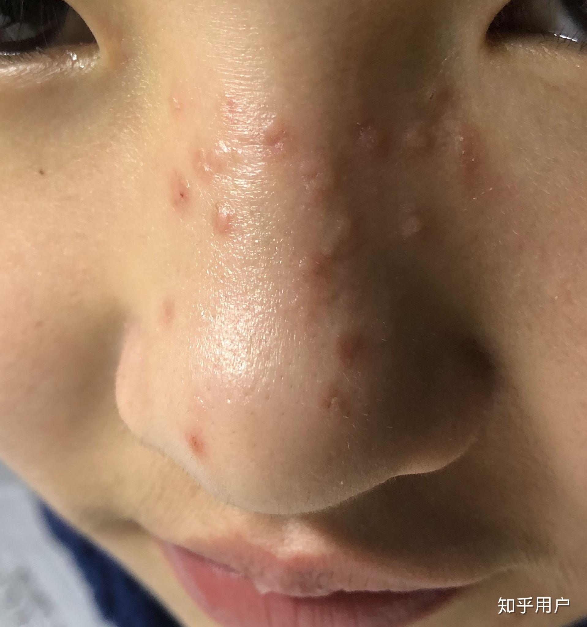 寻常疣扩散是个什么体验