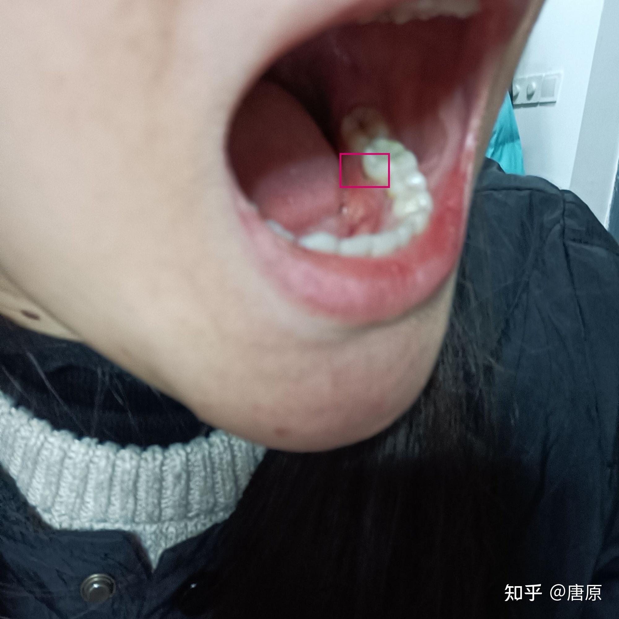 牙齿外面底部发黑