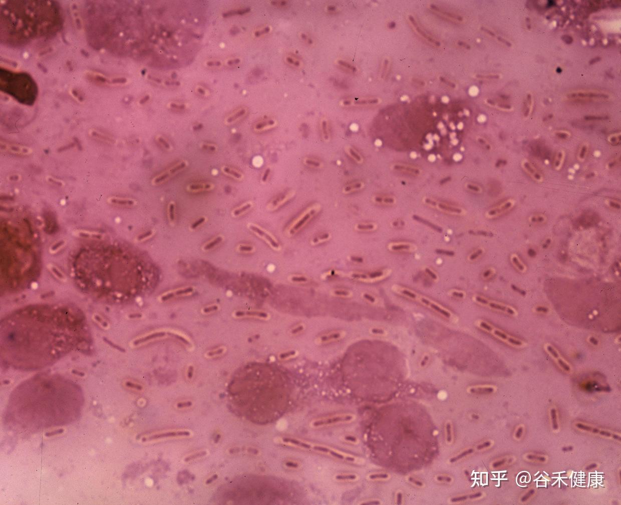 全面认识肺炎克雷伯菌klebsiellapneumoniae