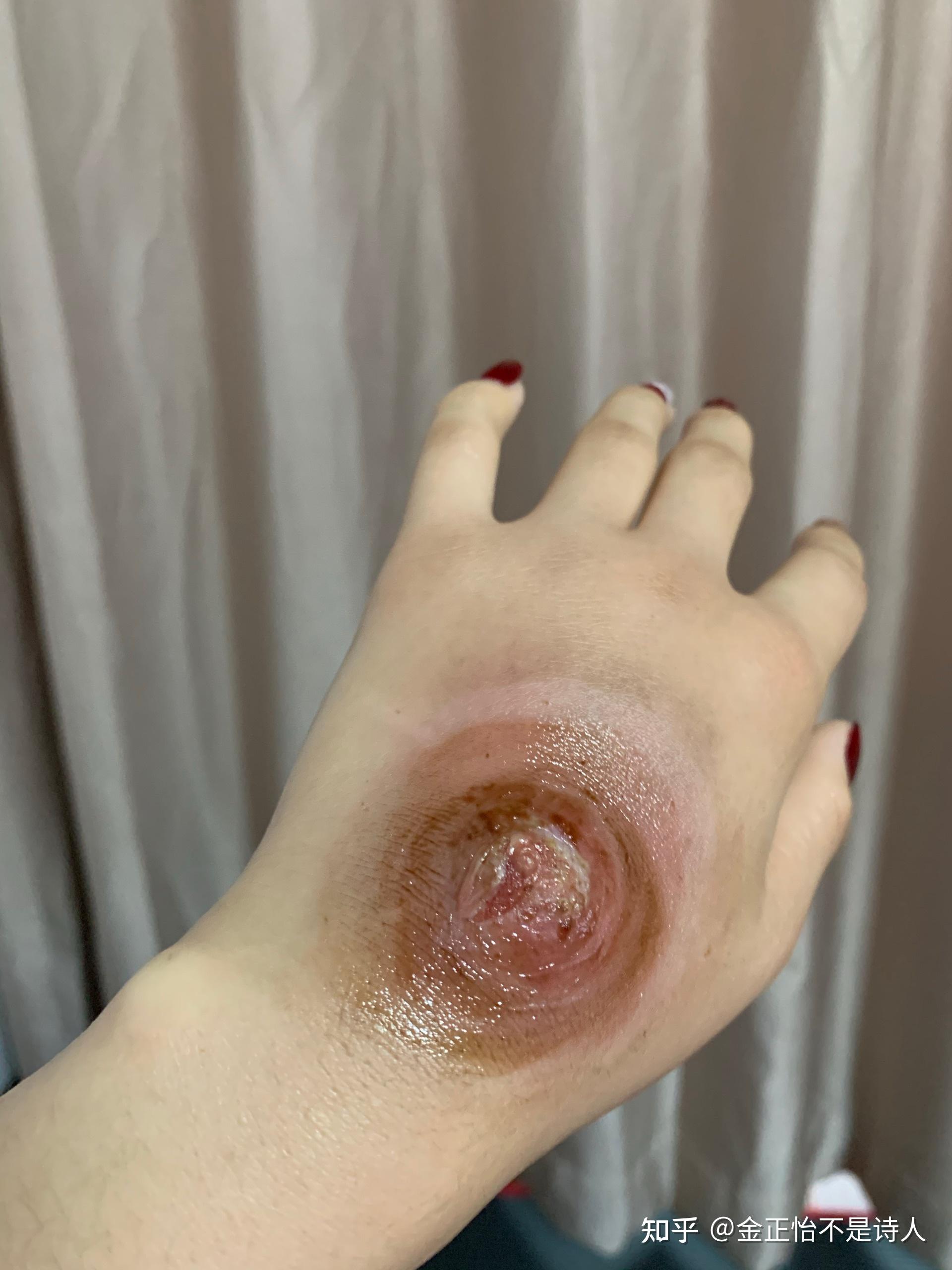 一个火疖子能大到什么地步? - 知乎