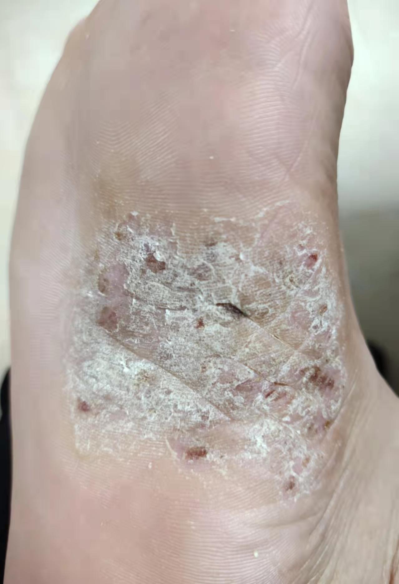 脚底起泡后皮肤有点溃烂.怎么办?