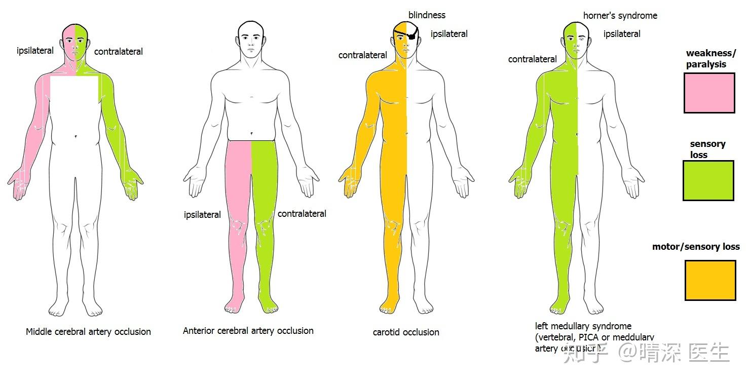肢体及躯干感觉障碍重于面部? - 知乎