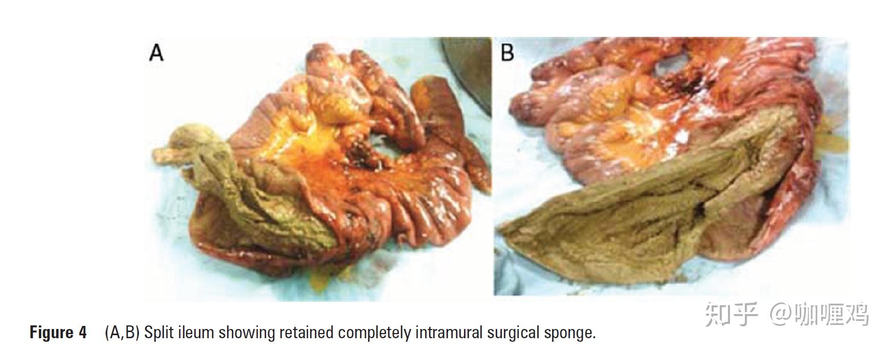 如何看待女子纱布入腹死亡被定性为一级甲等医疗事故谁应该承担主要