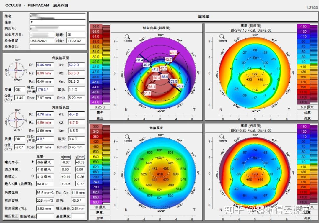 圆锥角膜的RGP验配及RGP临床效果分析（文字版） - 知乎