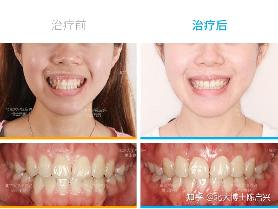 通过ebrace舌侧牙套单纯矫正的方式,就达到了改善骨突,改善露牙龈笑