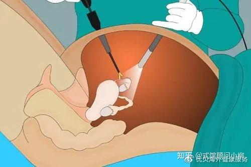 优贝生殖健康|试莞必备的检查之一 :宫腔镜详解