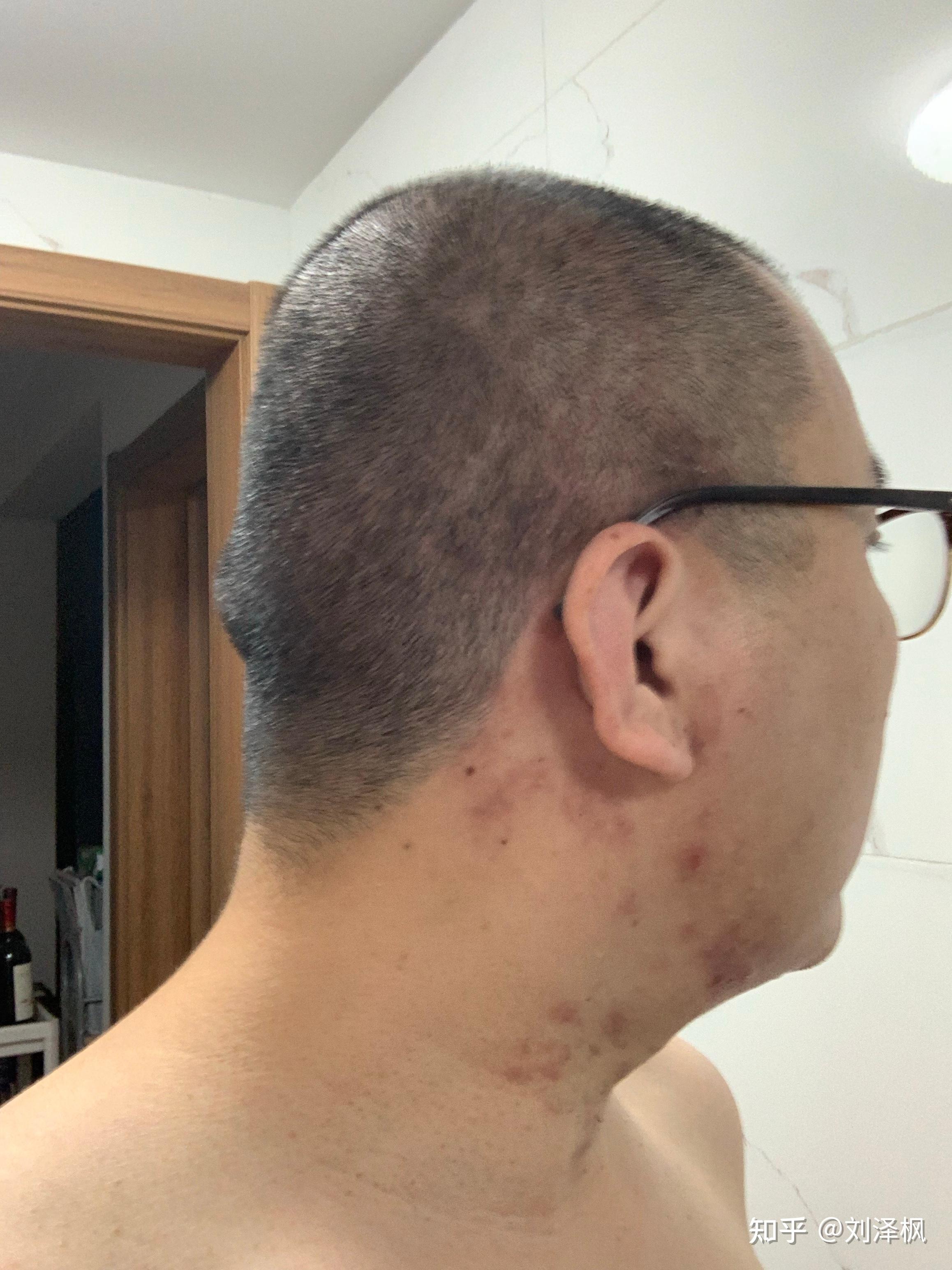 带状疱疹长脑袋上了