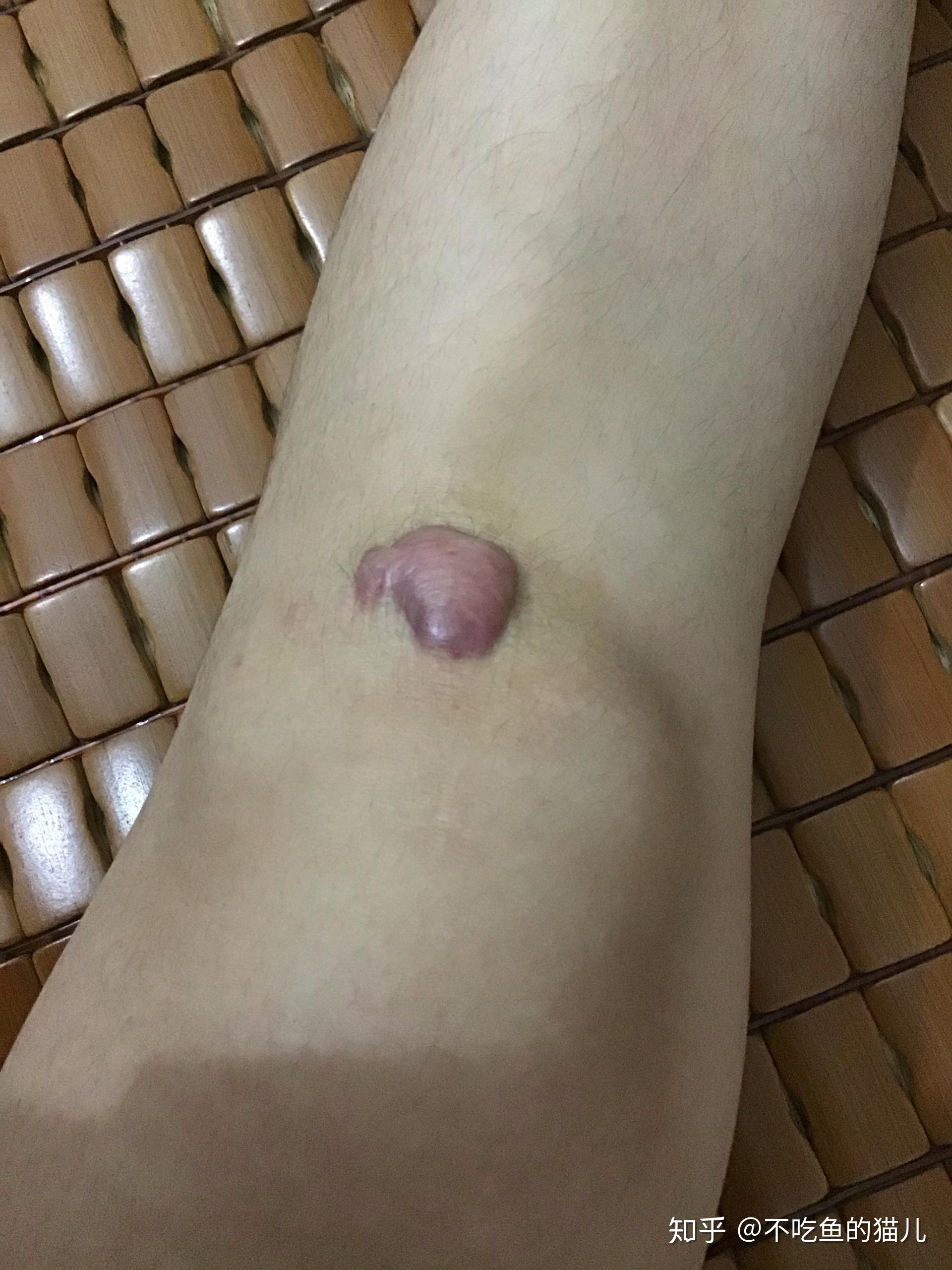 记录第一次疤痕注射