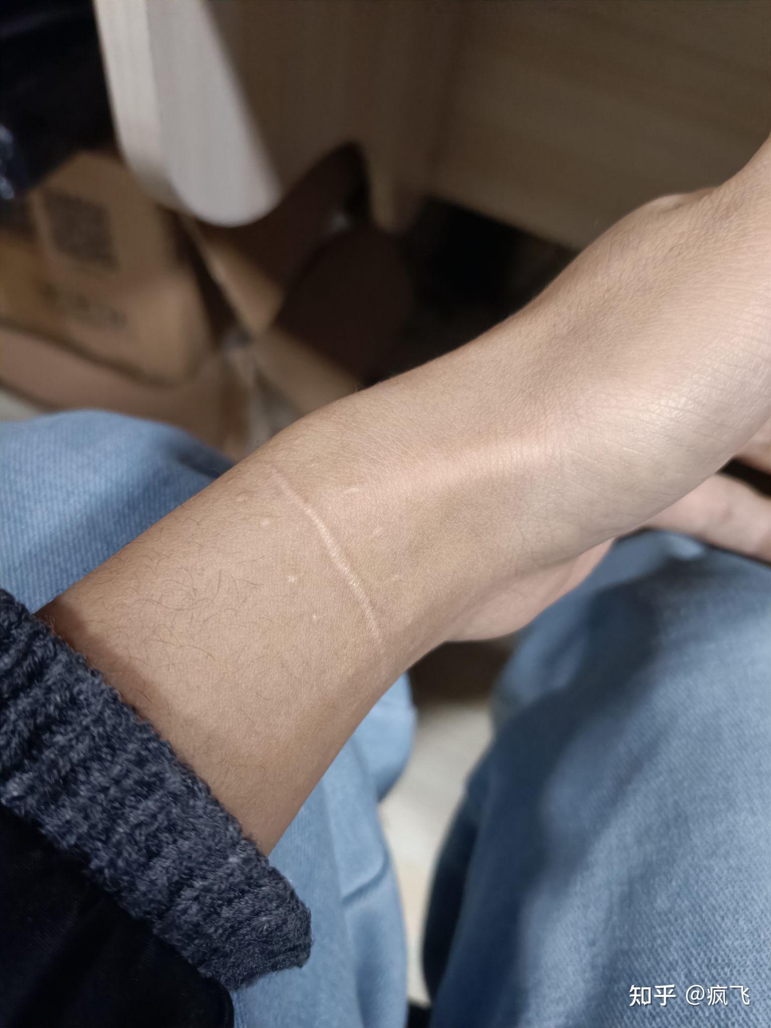 请问各位亲这种疤痕能当兵吗