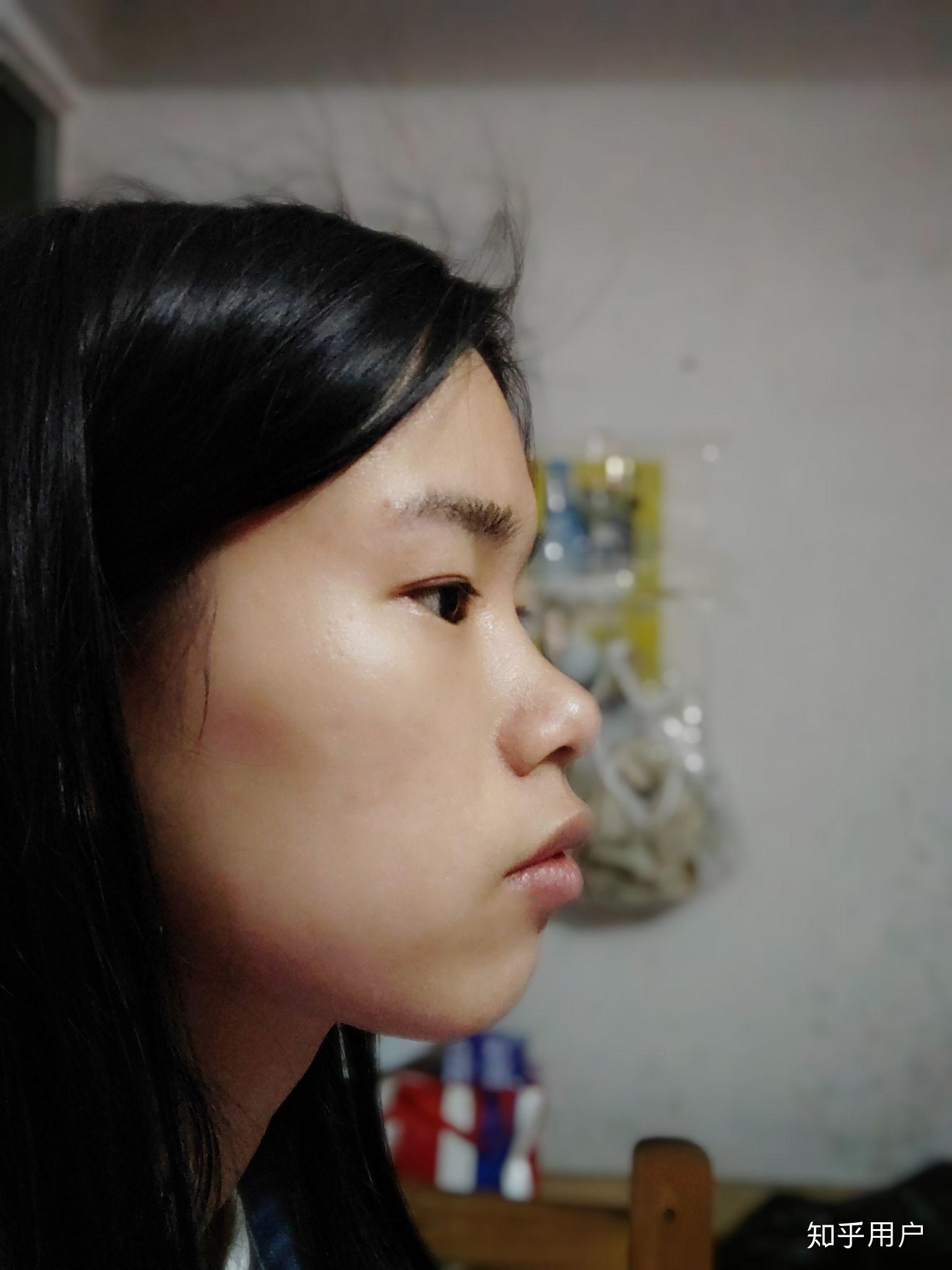 嘴凸,下巴後縮,從小張嘴呼吸,22歲女,側面很難看,如何治療?