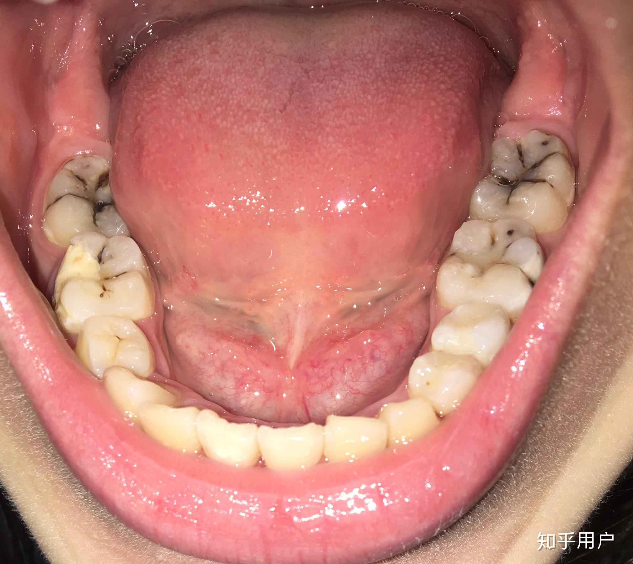20几岁就一口烂牙该怎么办? - 知乎