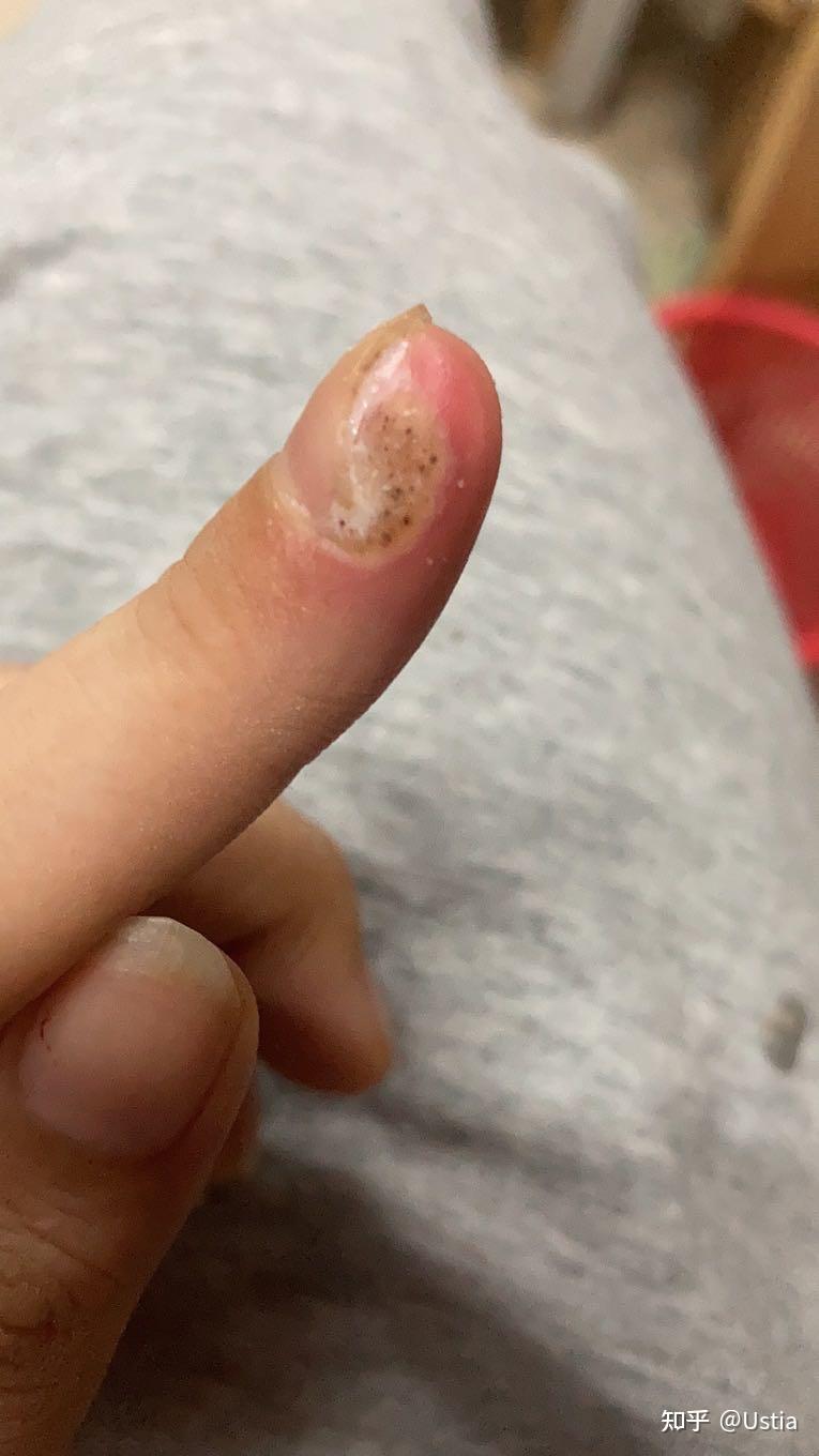 各位大神鄙人手残手指甲旁边长了死皮用指甲刀剪的时候把一些肉也剪了