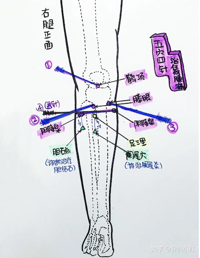 倪海厦针灸课笔记(60)- 疾病疑问解答之骨伤科、内科与针灸注意事项 - 知乎