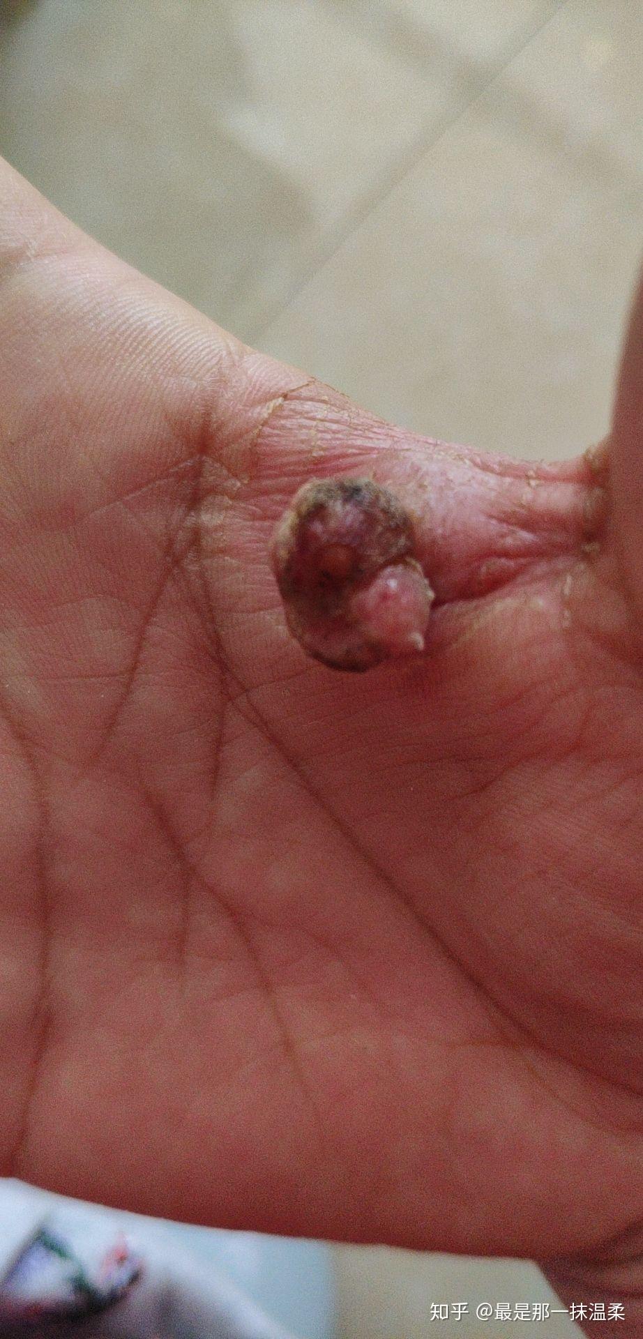 化脓性肉芽肿 - 知乎