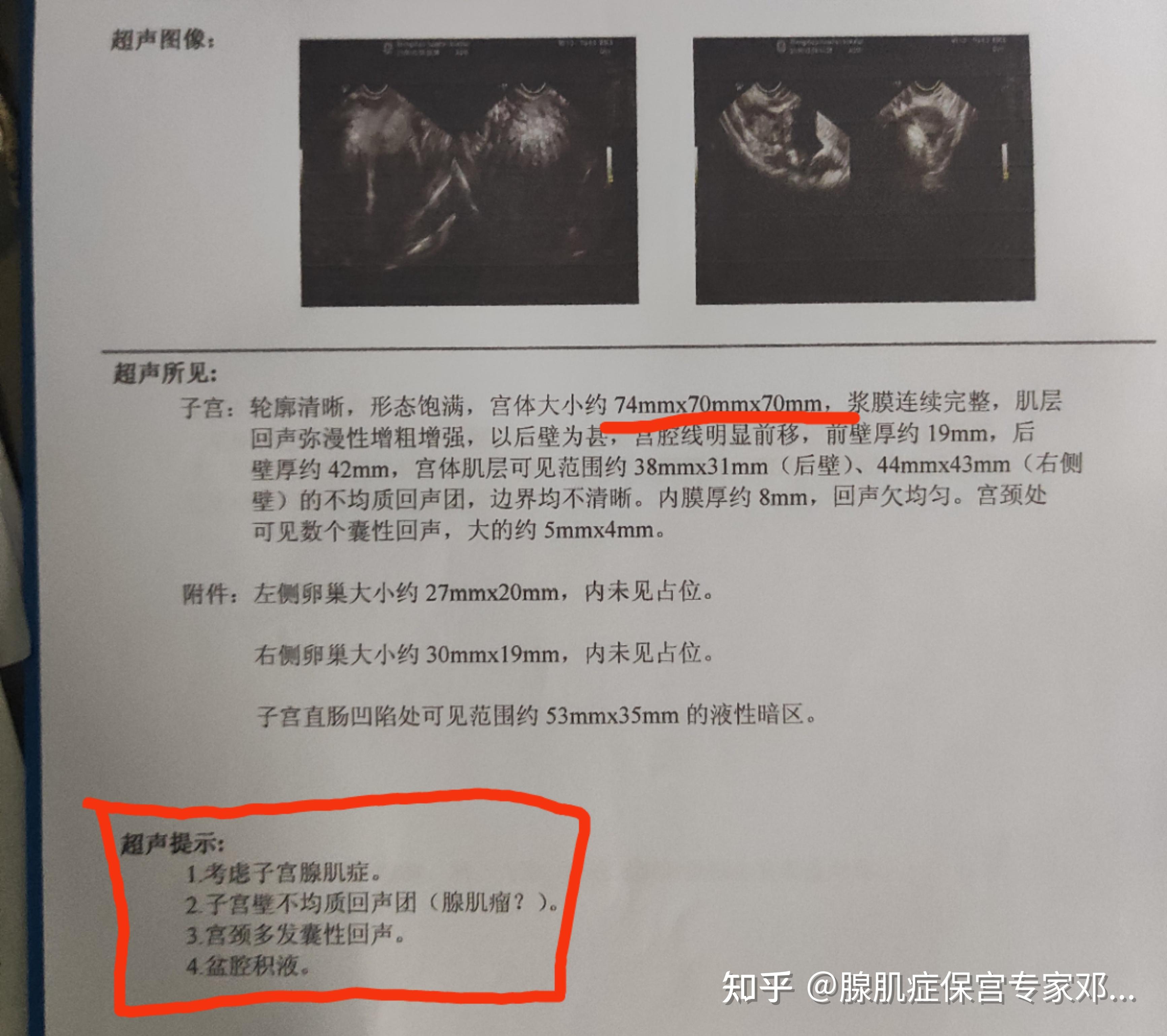 4年前,她被确诊是子宫腺肌病,因为长期月经量大,此时她已经出现贫血的
