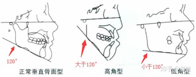 当角度小于120°就会变成低角型,就需要截骨改变角度和线条来达到改善