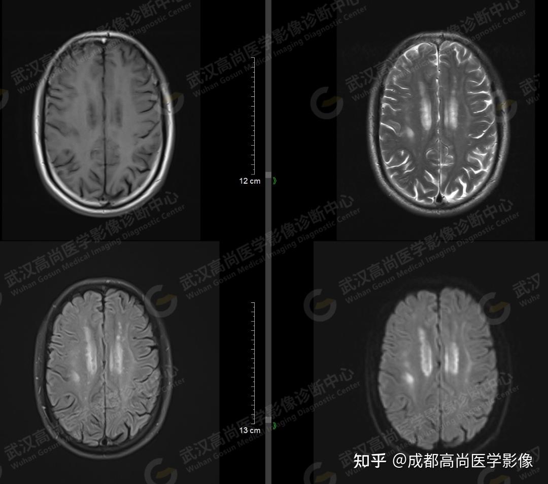 【高尚病例】因常年酗酒出现精神恍惚，磁共振诊断胼胝体进行性变性一例 知乎