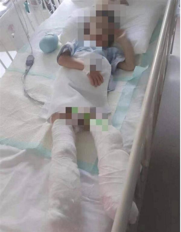 「被生母虐待致截肢」男童父亲称「腿没保住，希望能保住眼睛」，具体情况如何？