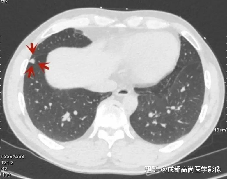 肺结节可以消失么